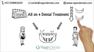 All on Four Dental Treatment Procedure 